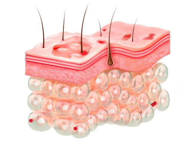 3D illustration of the cross-section of skin layers with atopic dermatitis