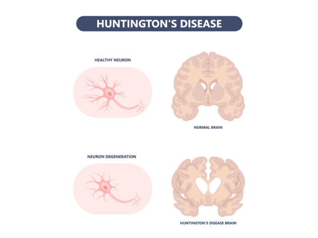 Illustration comparing healthy vs. Huntington's disease neuron and brain