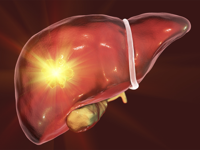 Liver tumor treatment conceptual illustration