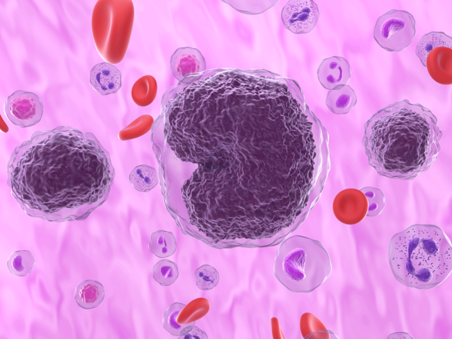 Non-Hodgkin lymphoma cells in the blood flow