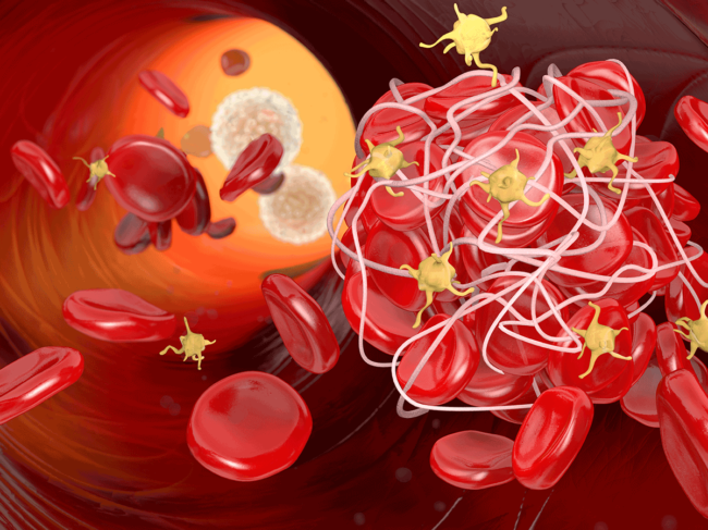 Thrombus in bloodstream with platelets and fibrin
